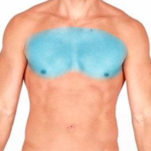 PECHO COMPLETO 6 SESIONES SOPRANO ICE