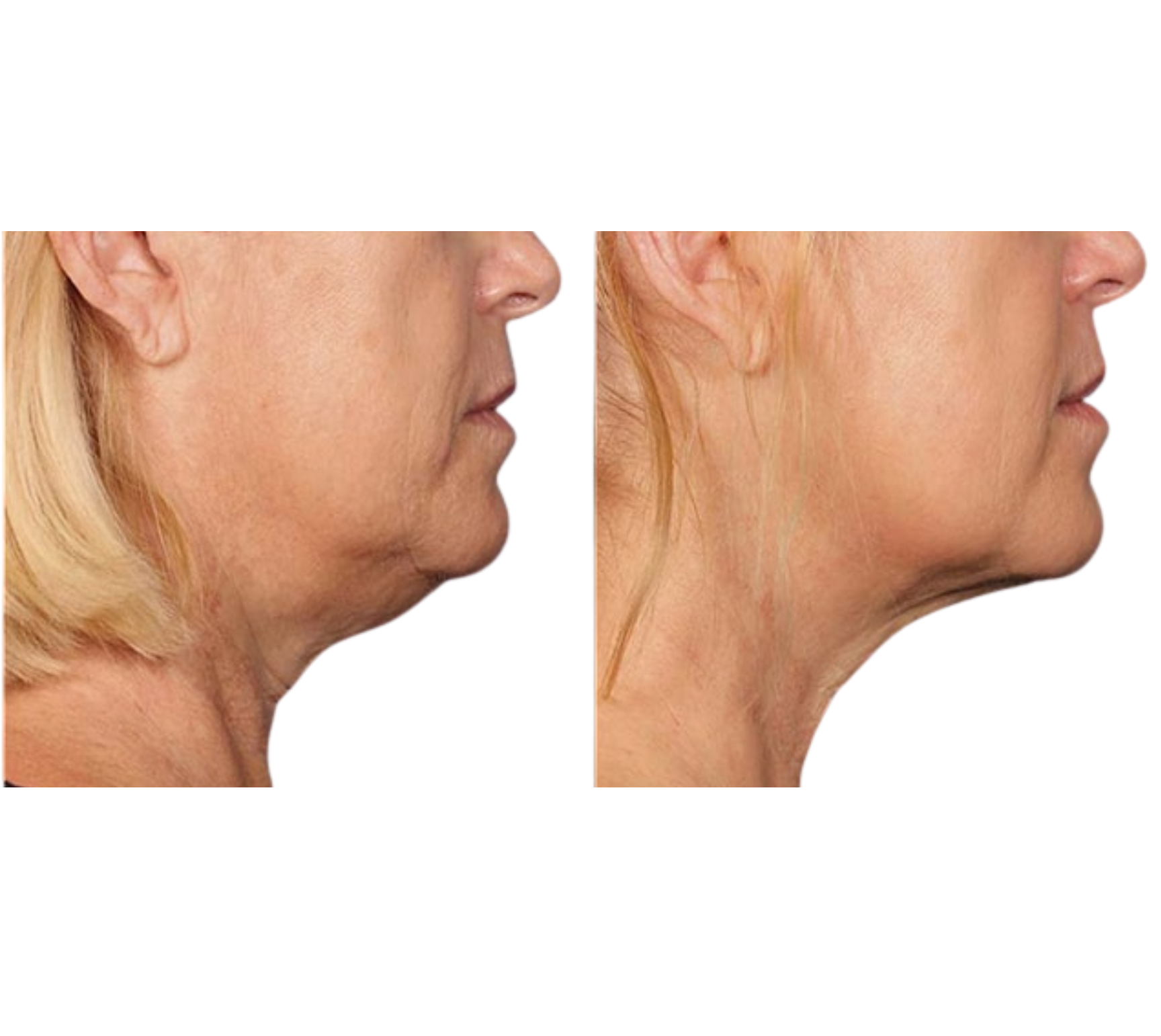 Pack Adiós a la Papada + Lifting Facial – Full Face (12 Sesiones)