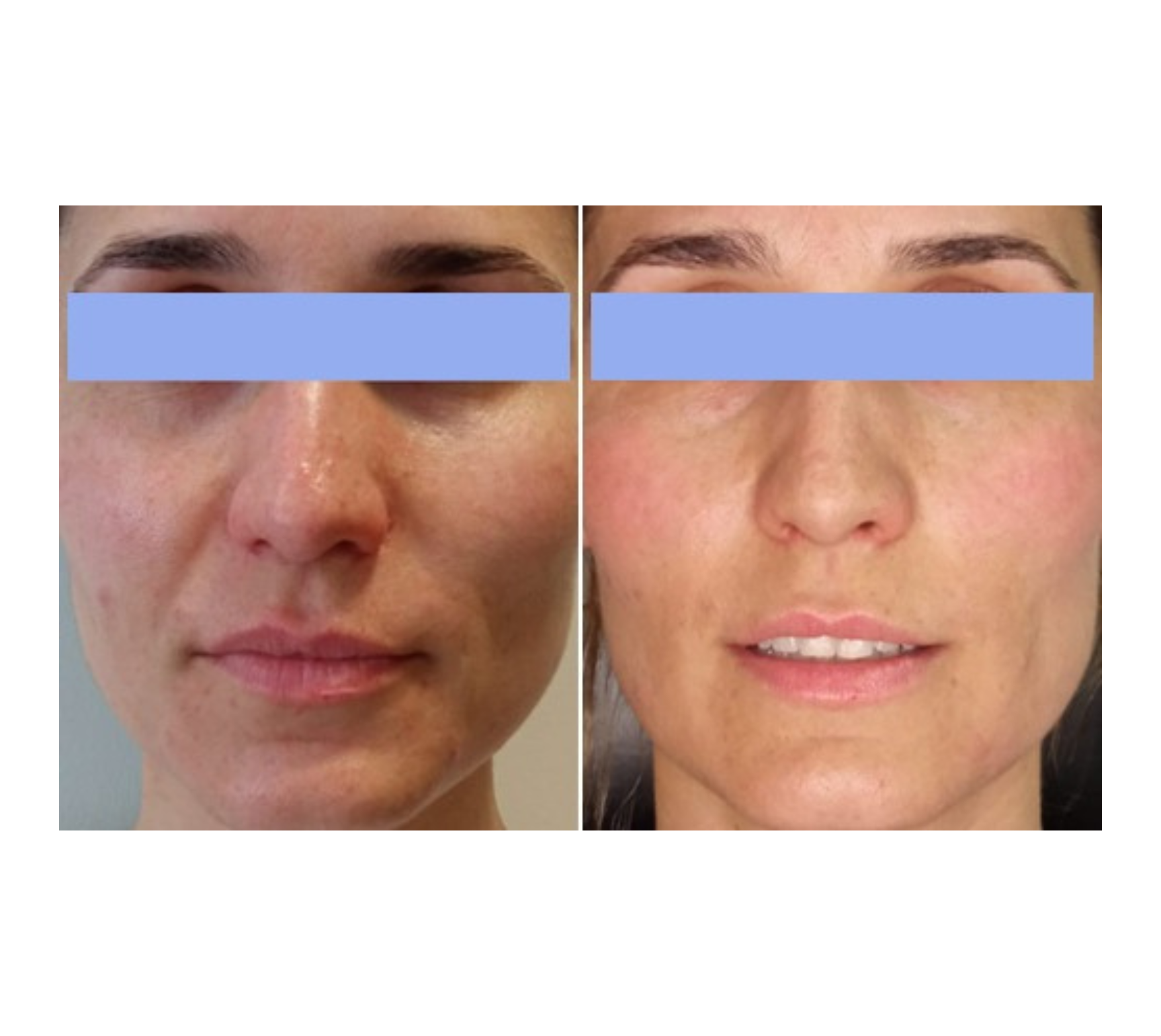 Pack Adiós a la Papada + Lifting Facial – Full Face (12 Sesiones)