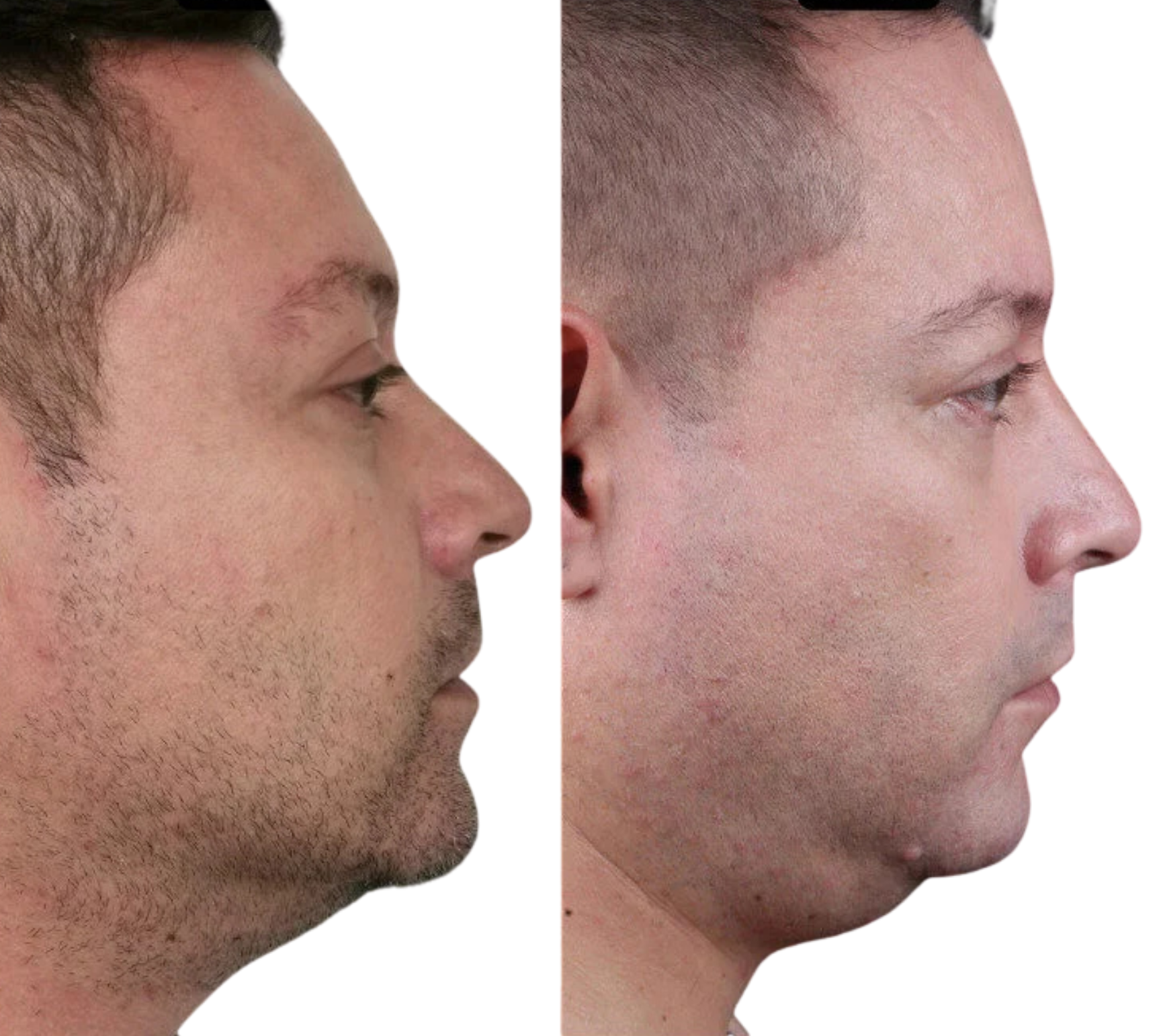 Pack Adiós a la Papada + Lifting Facial – Full Face (12 Sesiones)