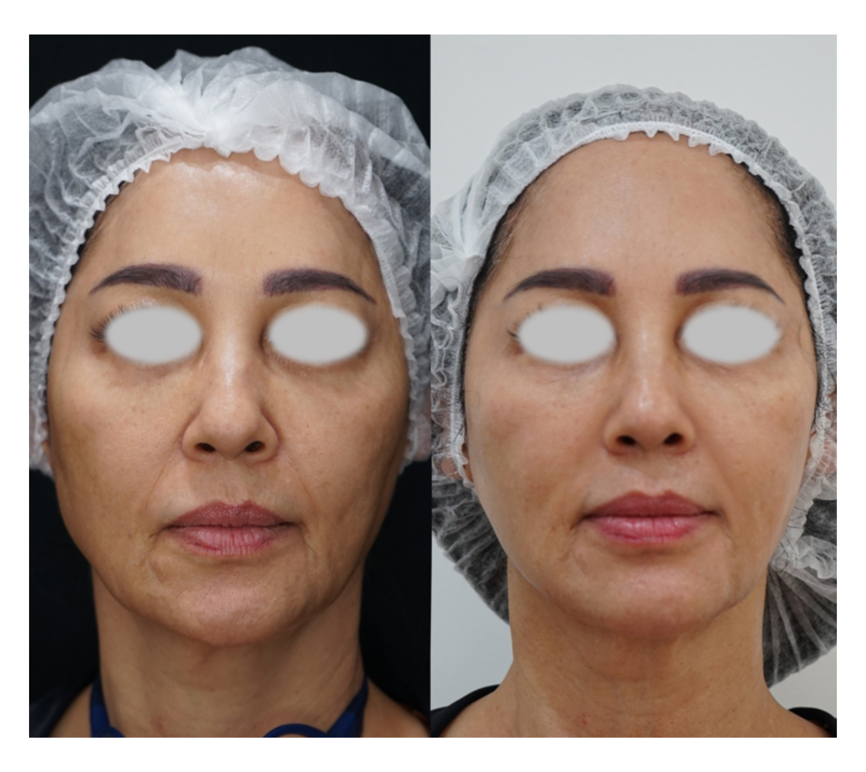 Pack Adiós a la Papada + Lifting Facial – Full Face (12 Sesiones)